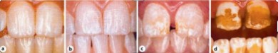 effects of fluoride on body