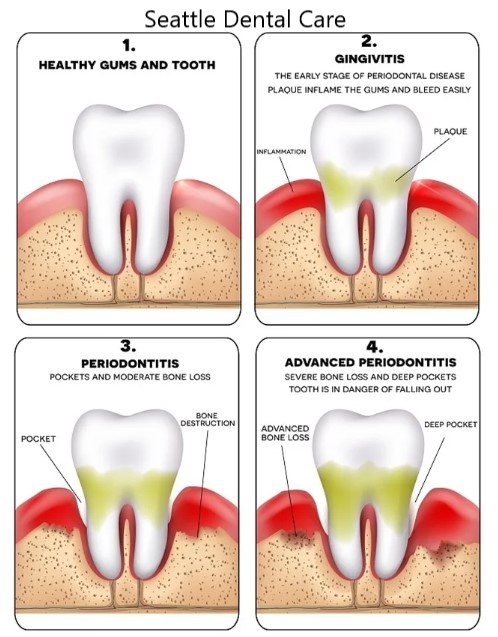 gum disease, natural ways to treat gum disease, gingivitis