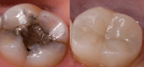 amalgam removal, mercury filling removal