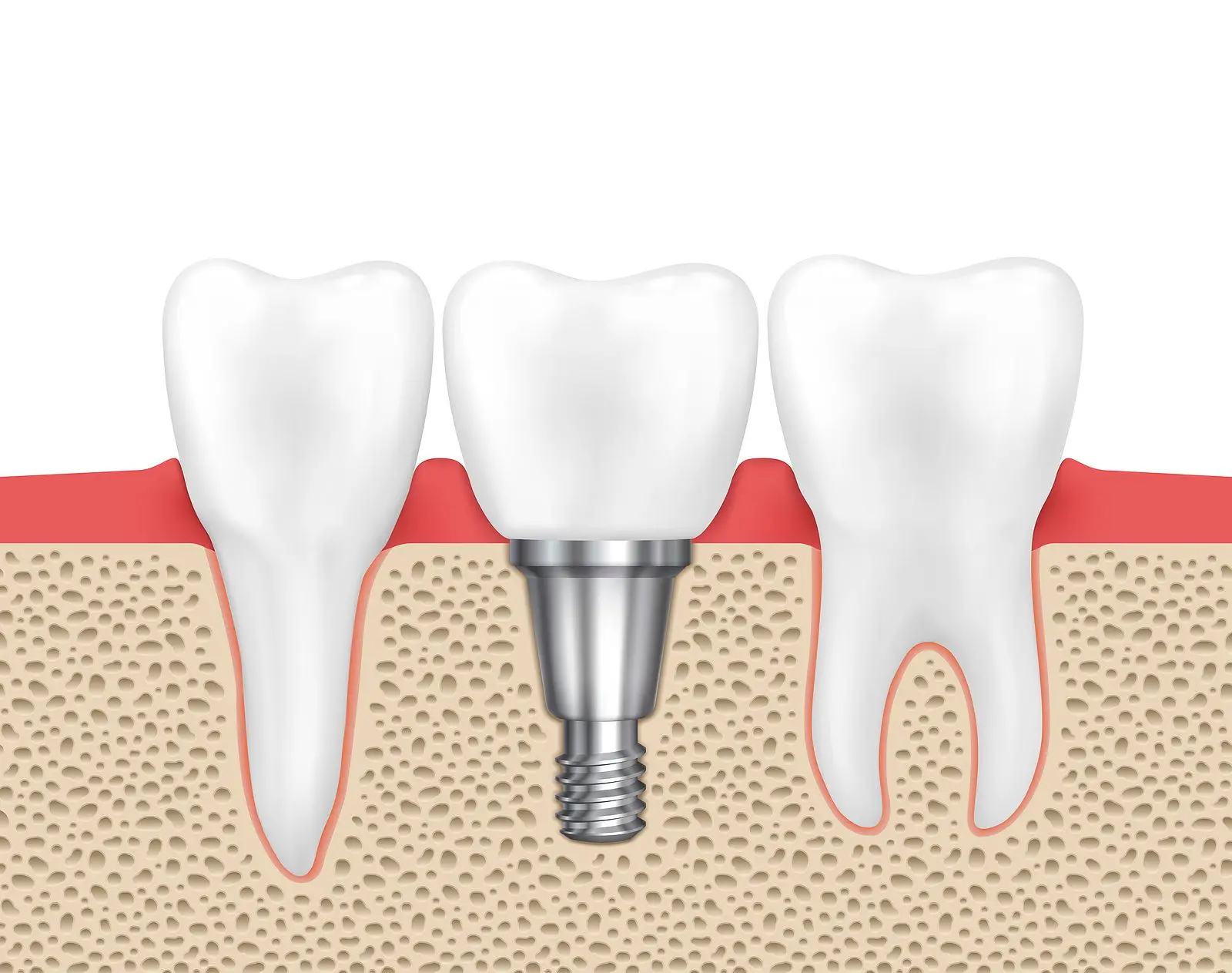 Ceramic Implants