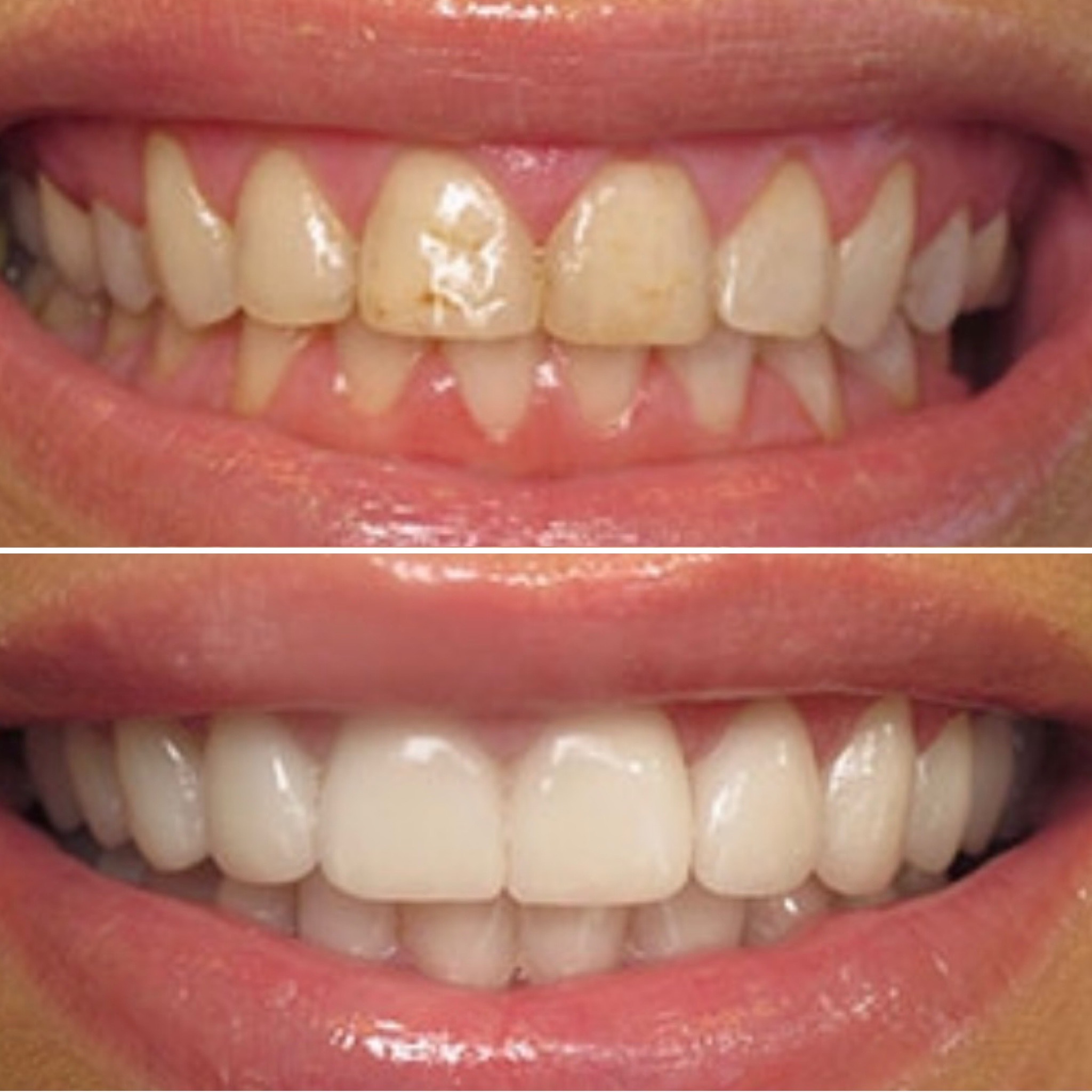 biological veneer, cosmetic veneer biological veneer, cosmetic veneer