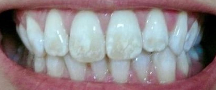 fluoride excess teeth, fluoride negative effects