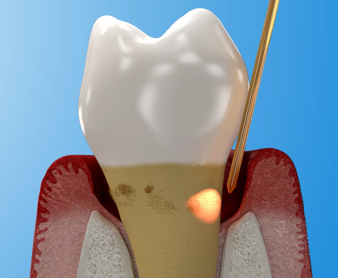 Laser dentistry Seattle Dental Care Laser dentistry Seattle Dental Care