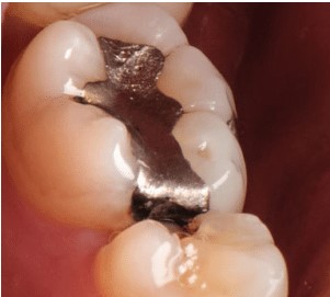 mercury removal dentist natural dentist near me whole body dentistry near me